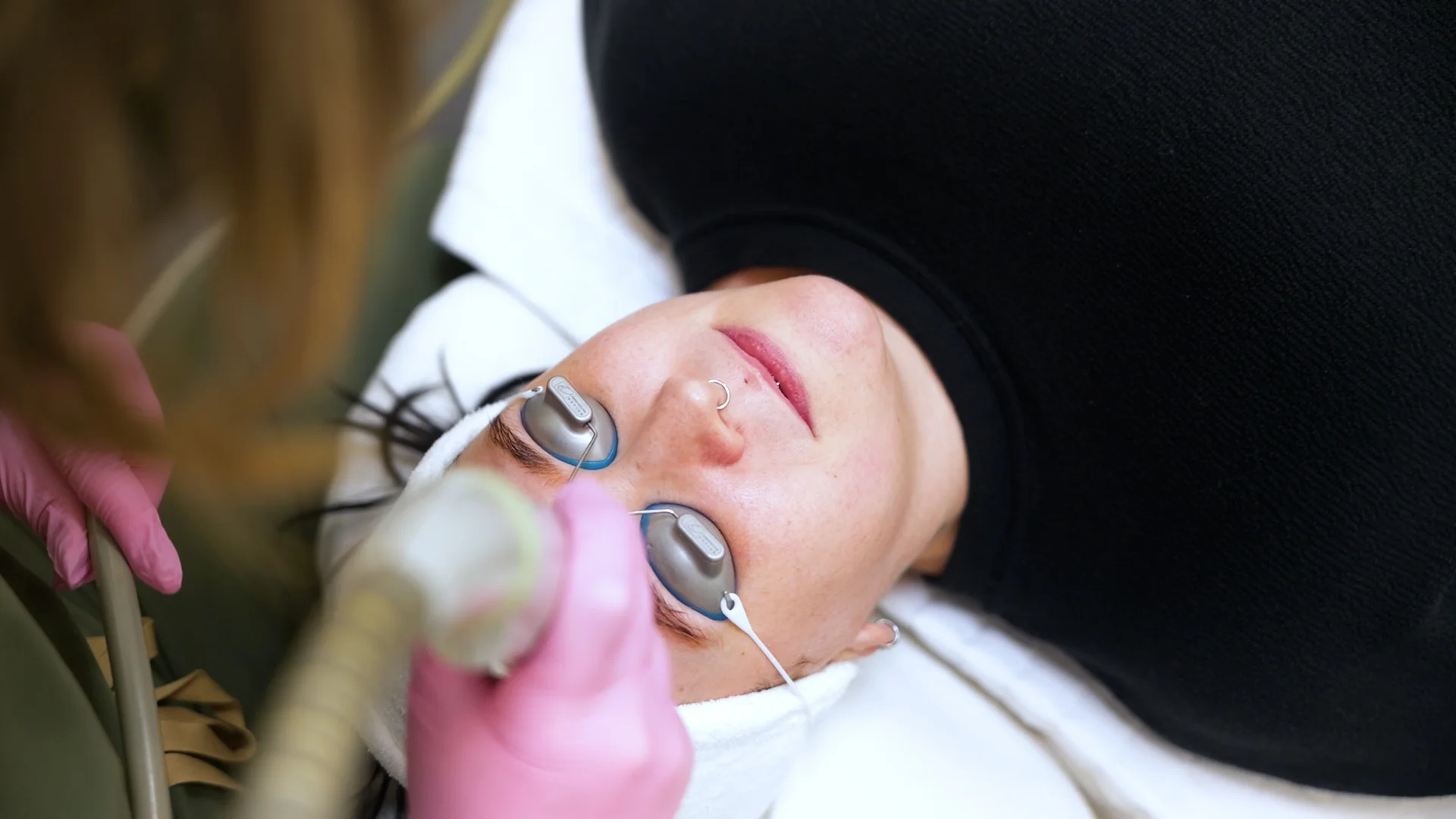 YAG - LASER GENESIS - IPL_24