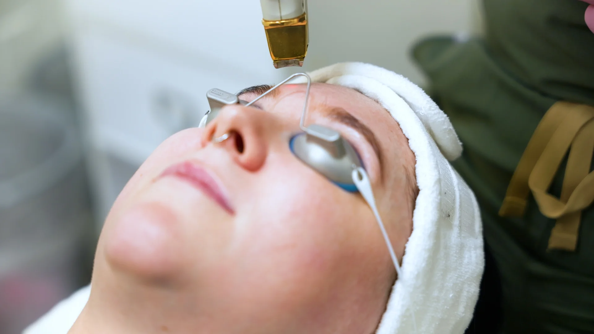 YAG - LASER GENESIS - IPL_30