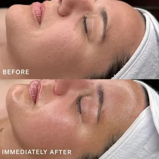 PicoWay Before & After 8
