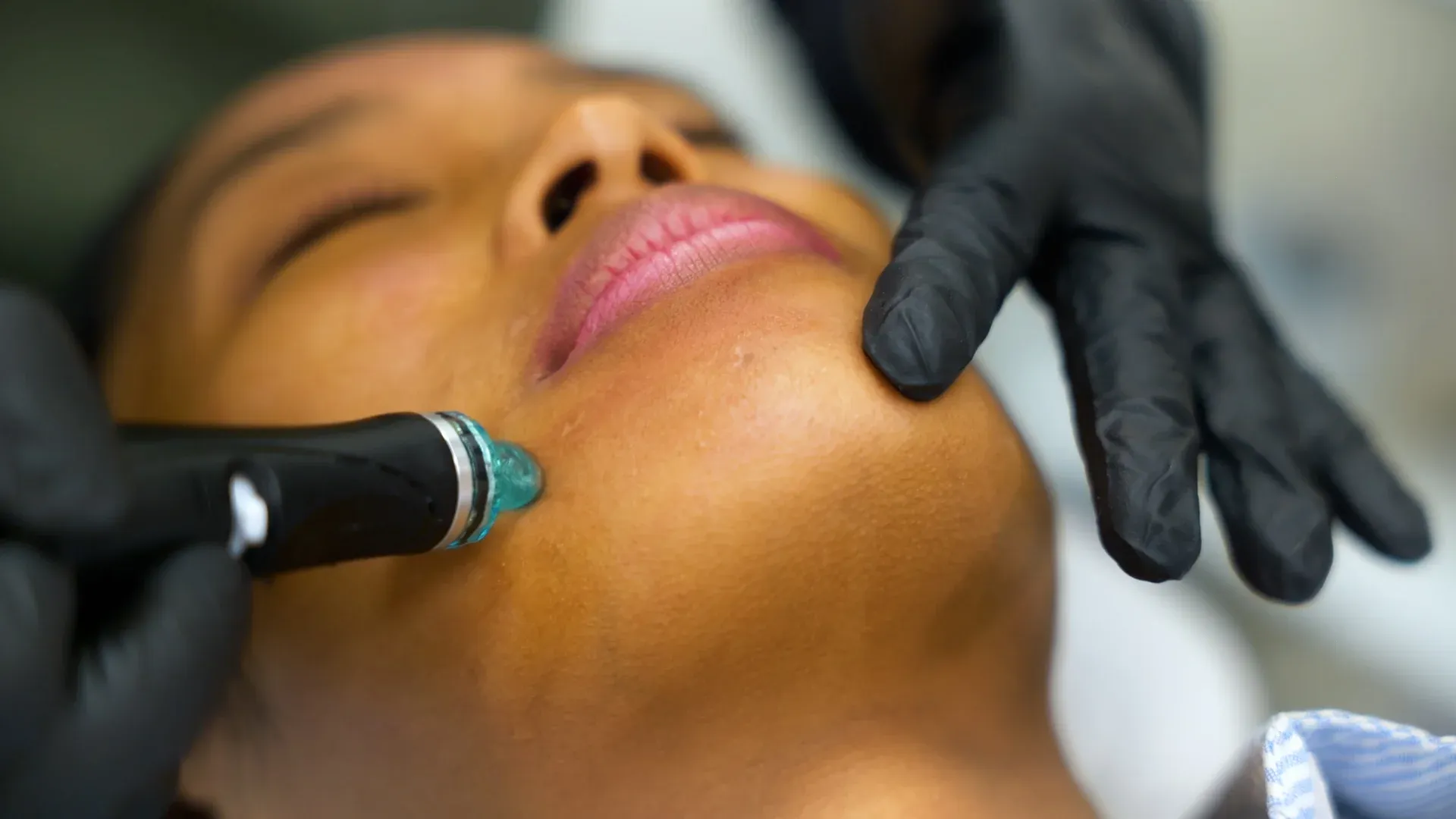 PicoWay Tattoo Removal Gallery 8