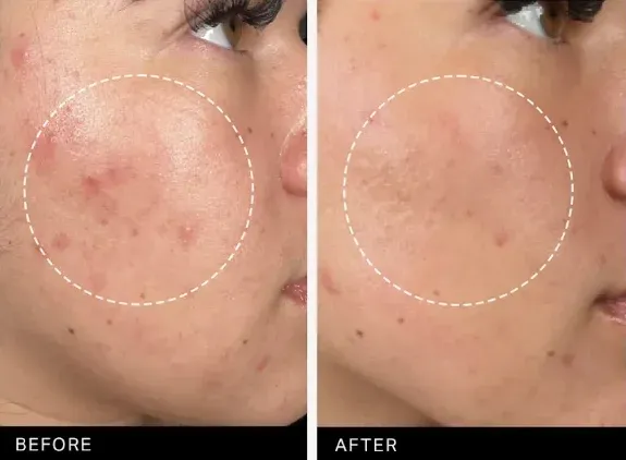 PicoWay Before & After 9