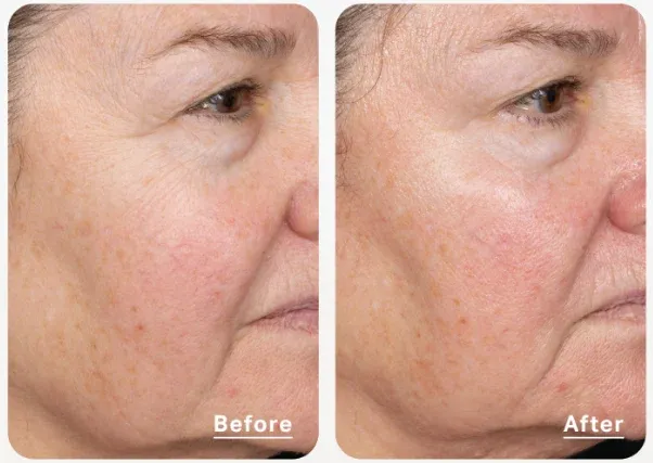 PicoWay Before & After 9