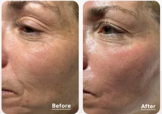 PicoWay Before & After 10