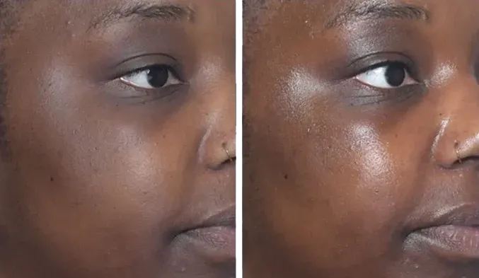 PicoWay Before & After 7