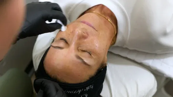 PicoWay Tattoo Removal Gallery 7
