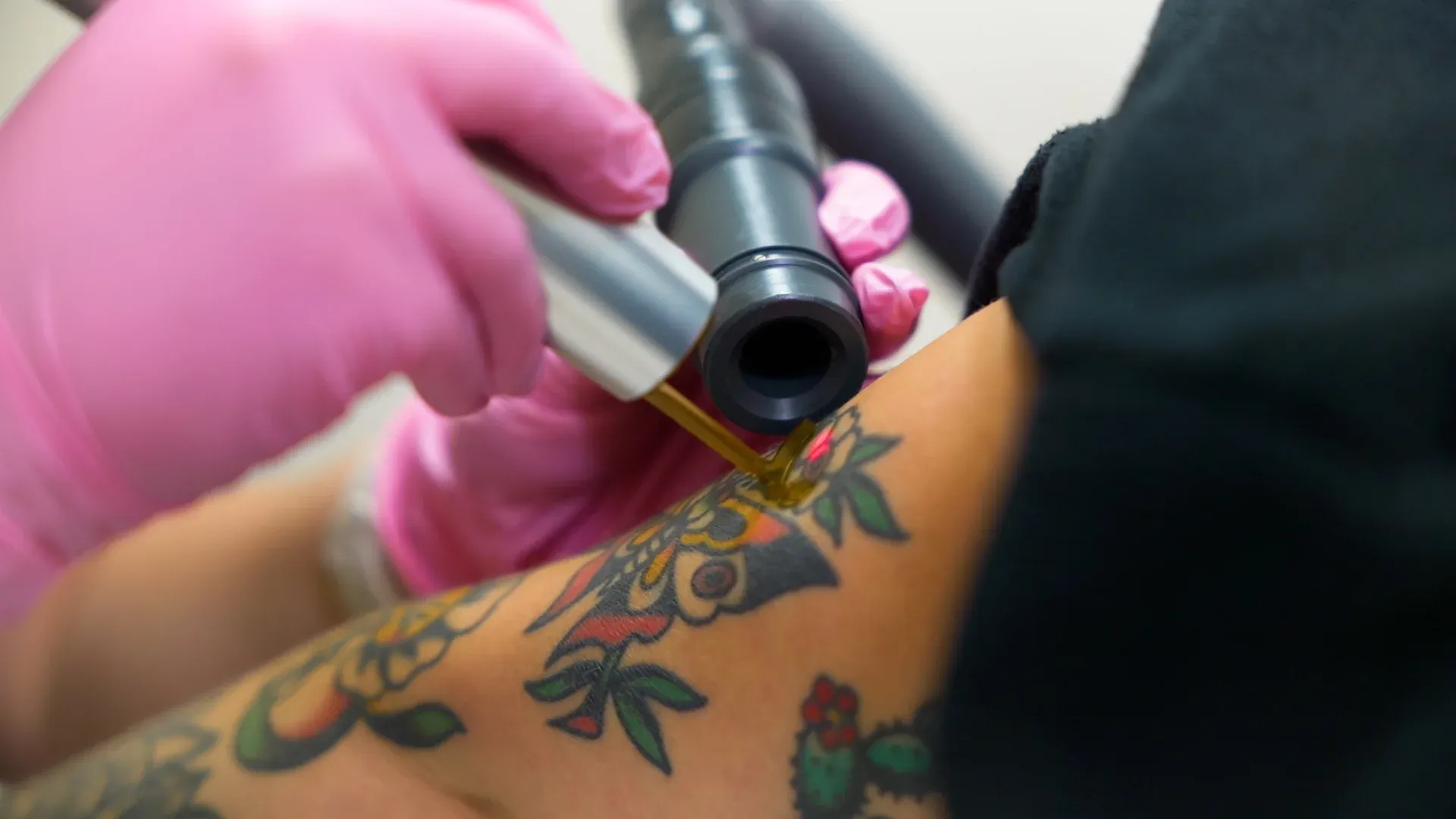 PicoWay Tattoo Removal Gallery 4