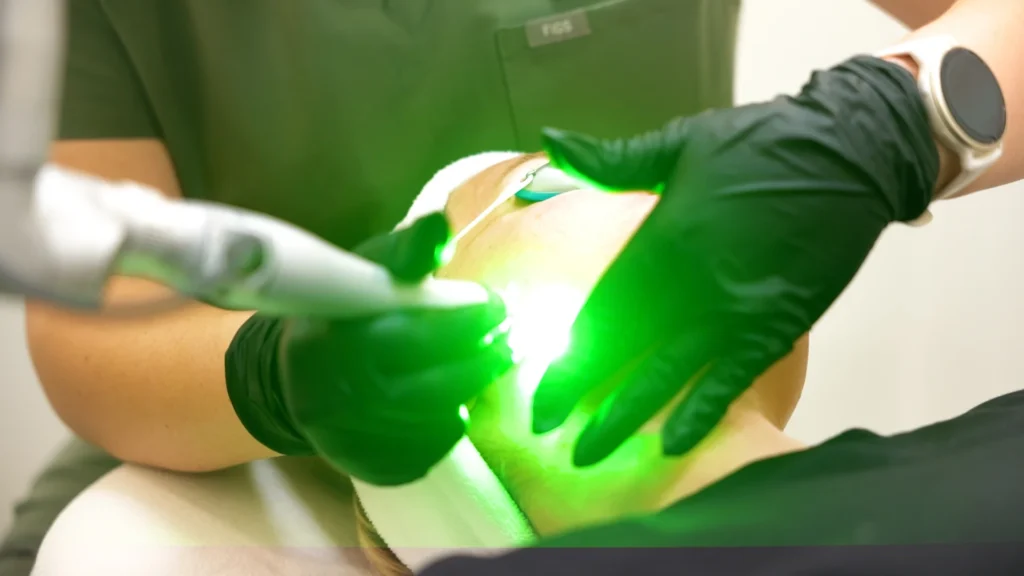 PicoWay Resolve fractional laser for acne scars in Kelowna at Healthpoint Cosmetic.